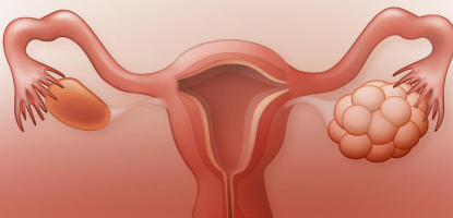 POLICISTIČNI JAJNICI