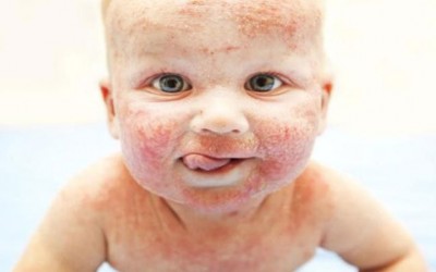 Atopijski dermatitis