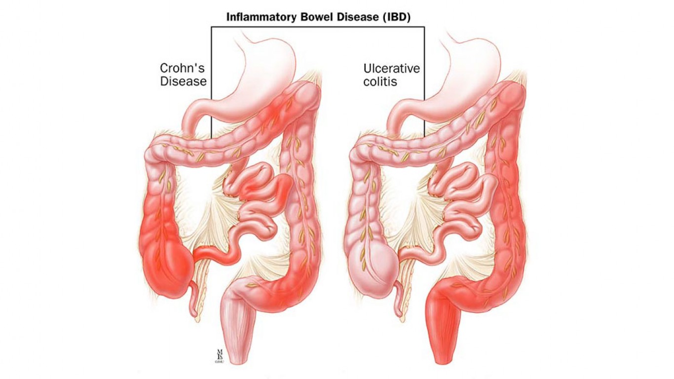 Inflamatorn bolest creva (IBC)